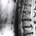 脊柱管狭窄症で痛みが出たら、○○を確認しましょう！・・・船橋市のオステオパシー整体